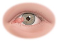 Pinguecula And Pterygium