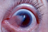 Pinguecula And Pterygium